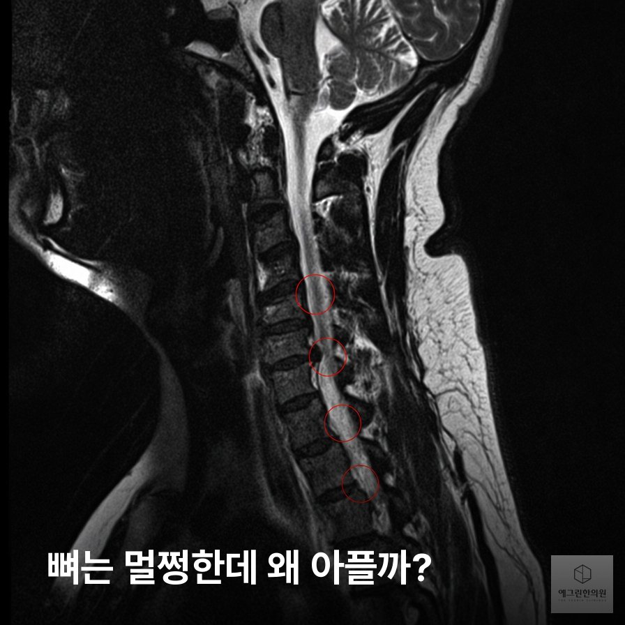 교통사고 후 검사에 이상 없어도 통증이 지속되는 이유