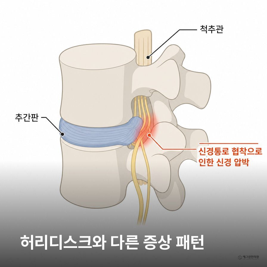 척추관협착증과 허리디스크 증상 차이