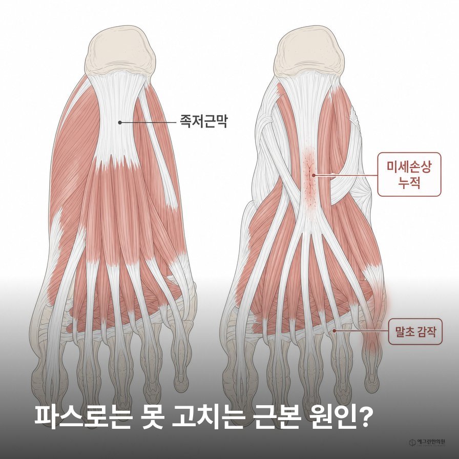 족저근막염 반복 원인과 족저근막 구조